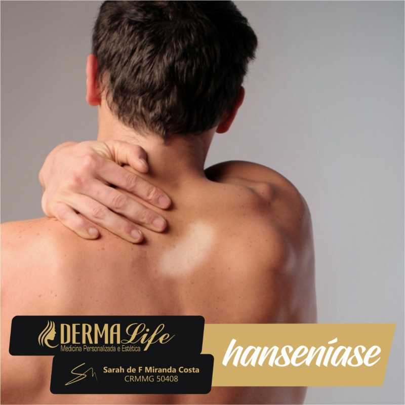 Conheça um pouco mais sobre a Hanseníase