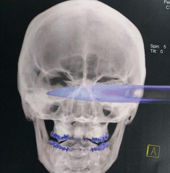Homem é agredido com facada nos olhos em Formiga