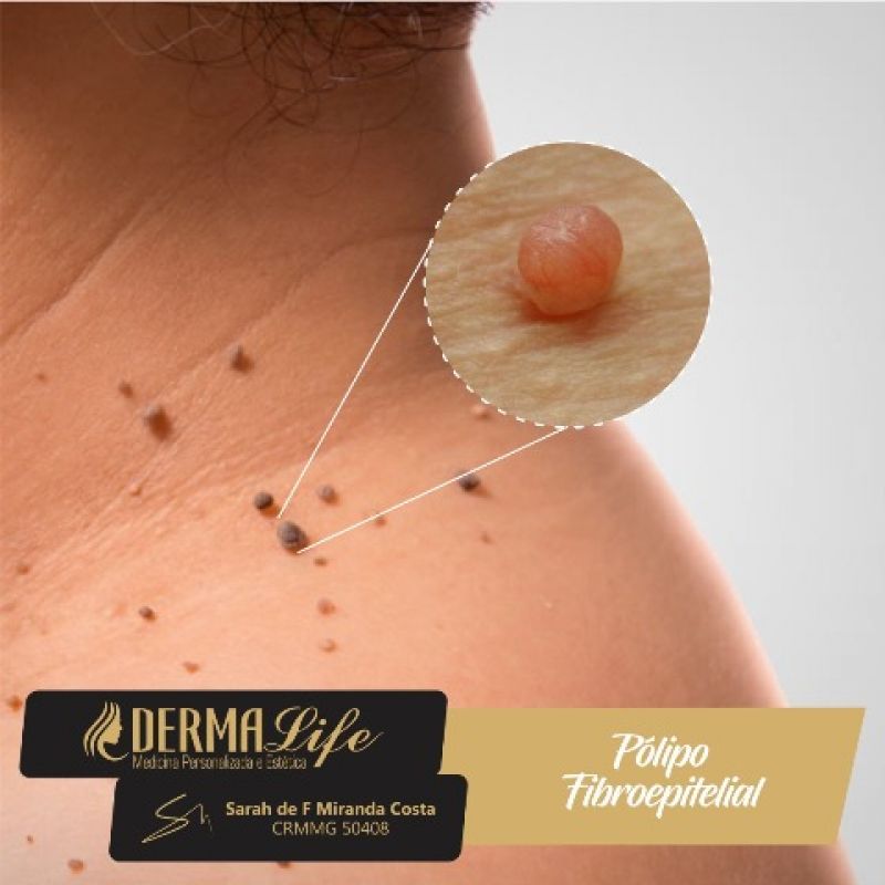 Pólipo Fibroepitelial