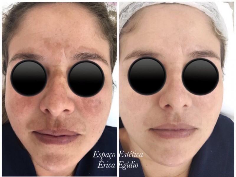 Tratamento do Melasma