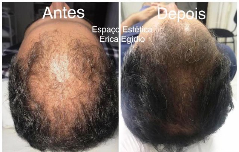 Alopecia androgenética ou calvície