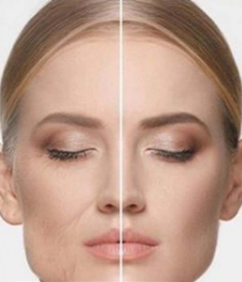Sculptra e o colágeno perdido