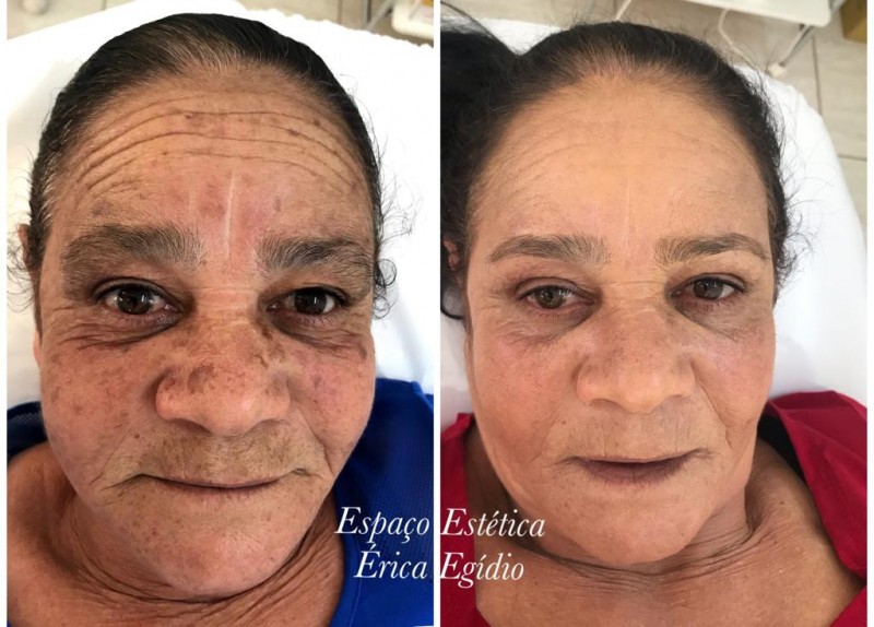 Tratamento do Melasma