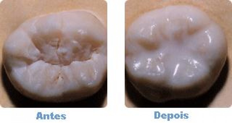 Selante Oclusal