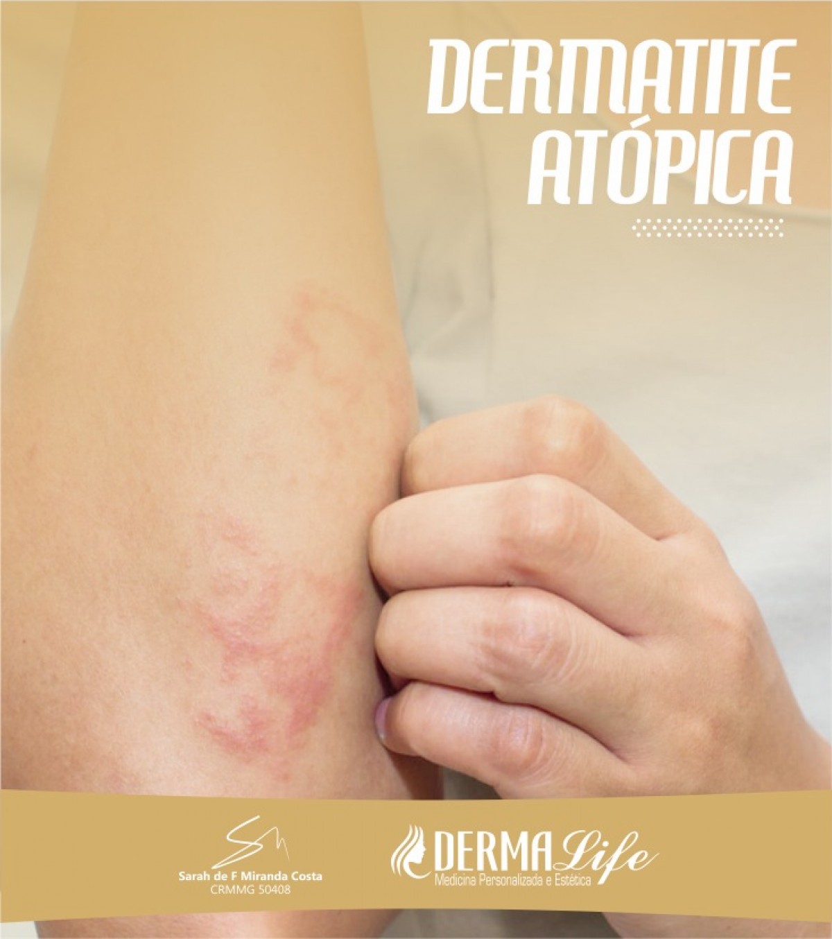 Dermatite Atópica