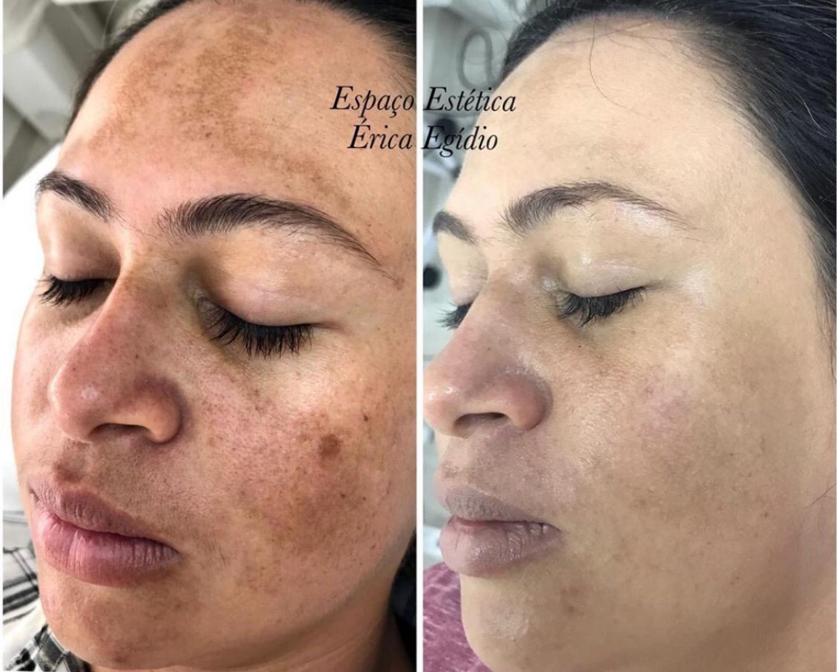 Tratamento do Melasma