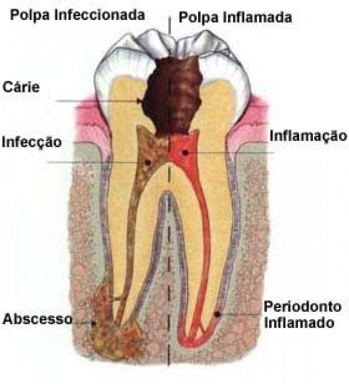 Abscessos bucais
