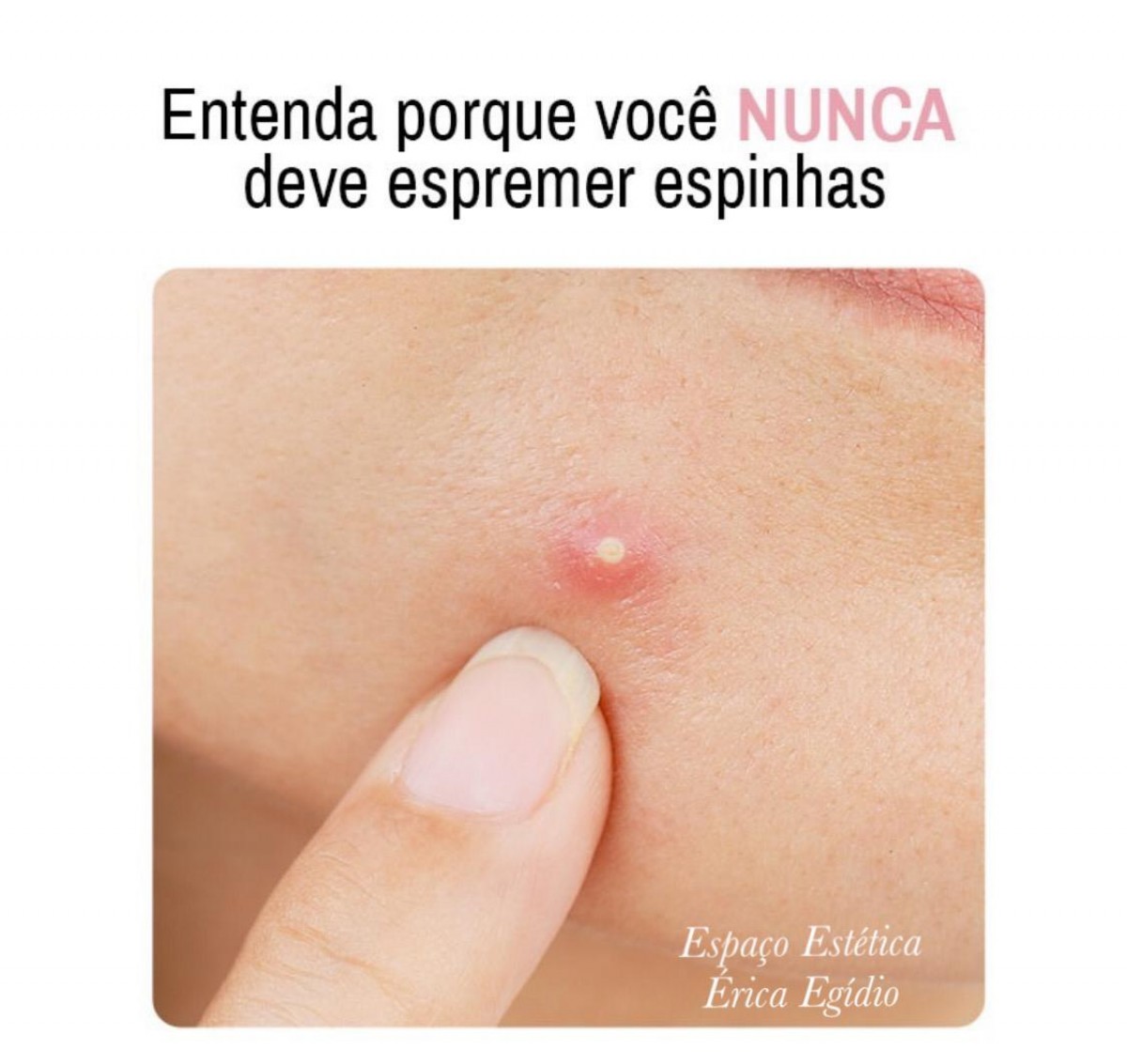 Entenda porque você nunca deve espremer suas espinhas