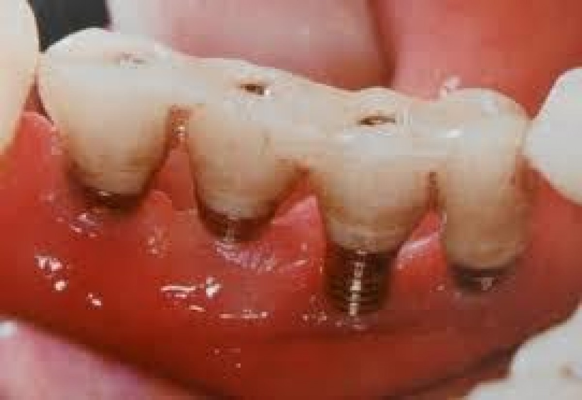 Peri-implantite