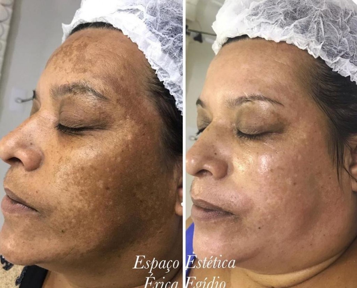 Tratamento do Melasma