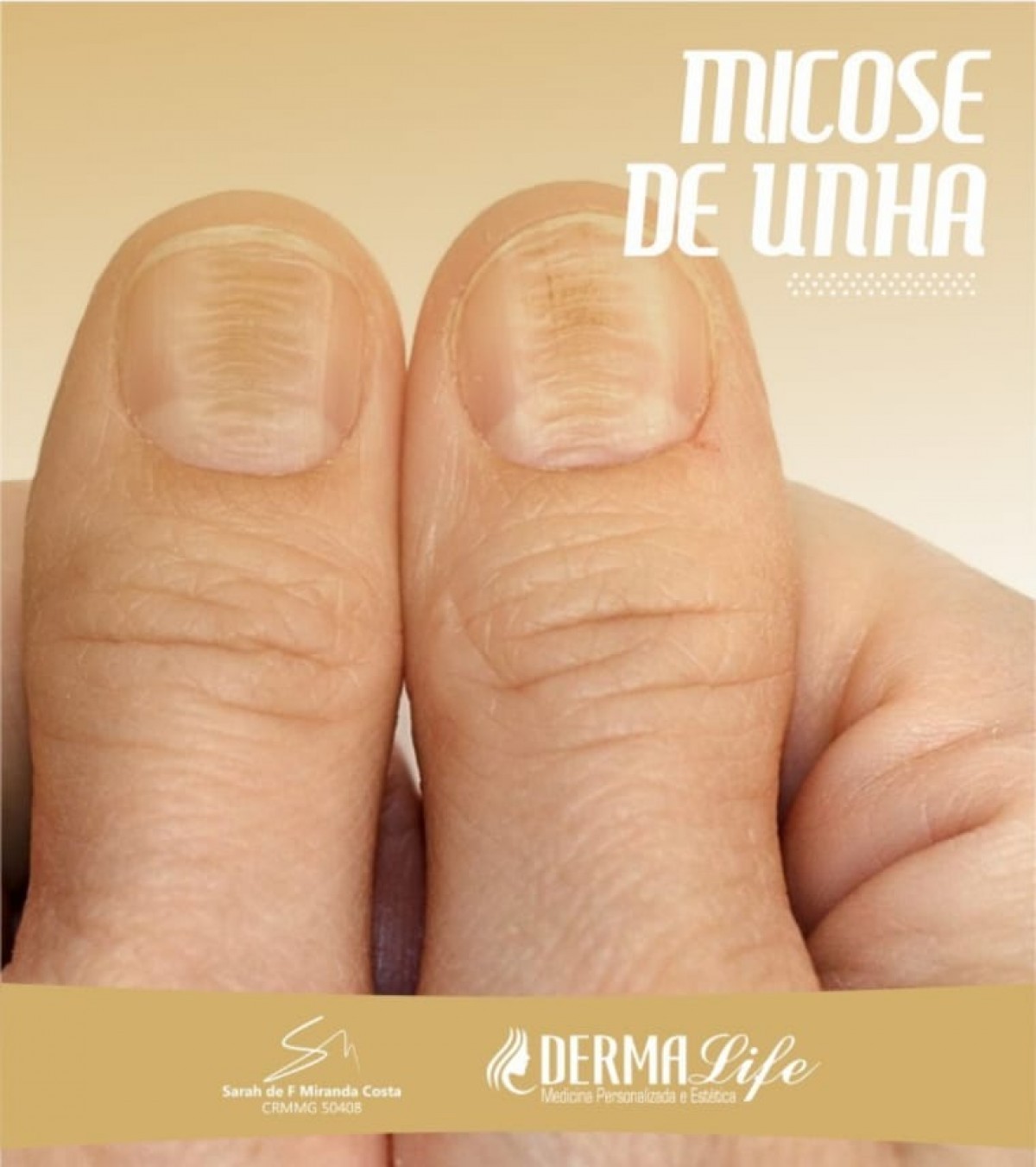 Micose de unha, saiba mais