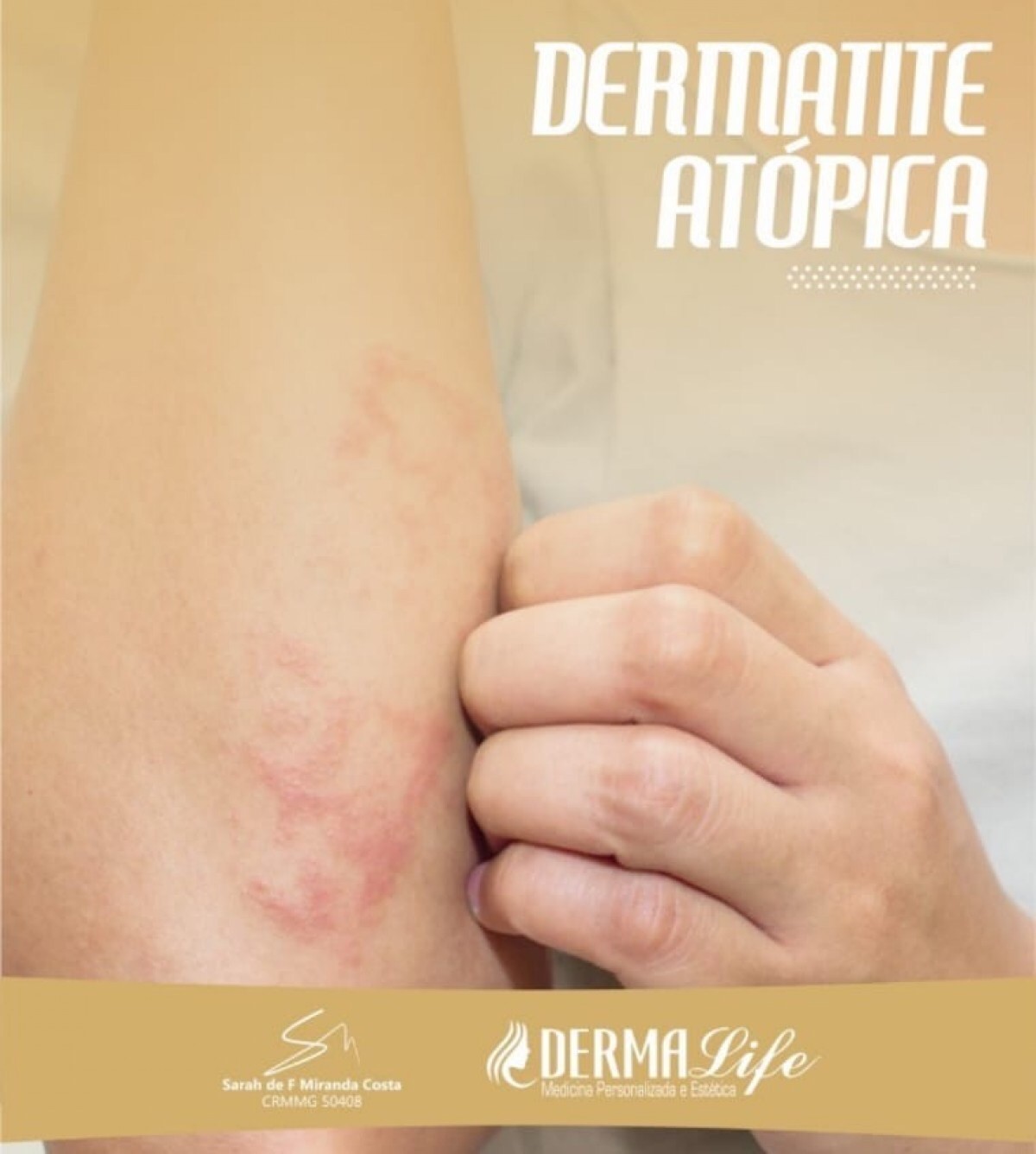 Dermatite Atópica