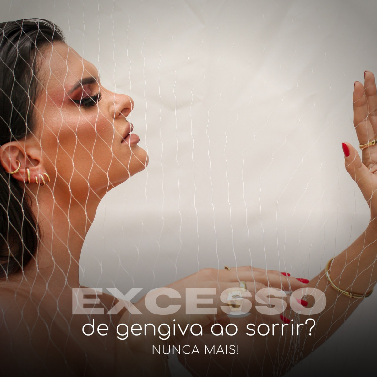 Já ouviu falar sobre o sorriso gengival?