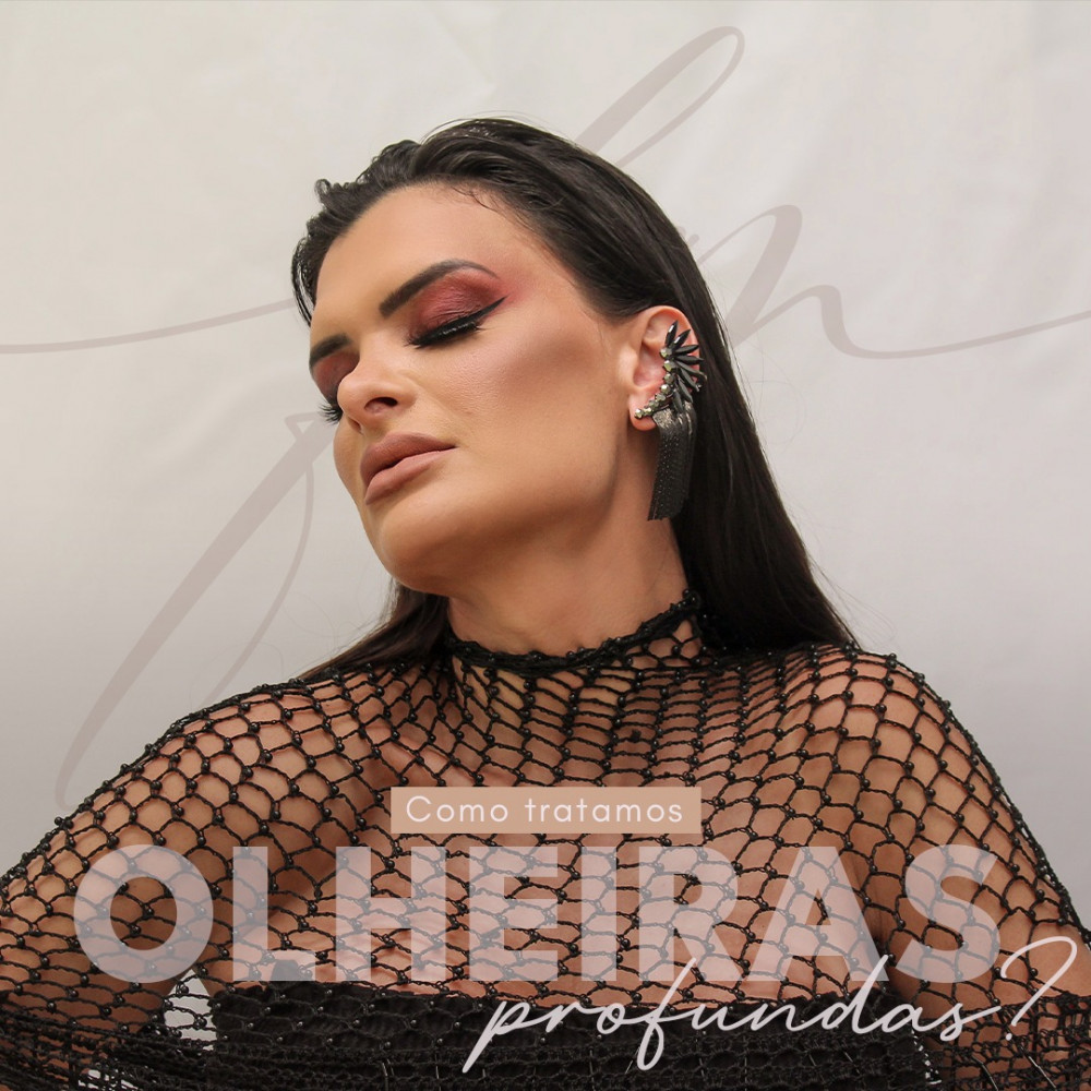 Como tratamos olheiras profundas?