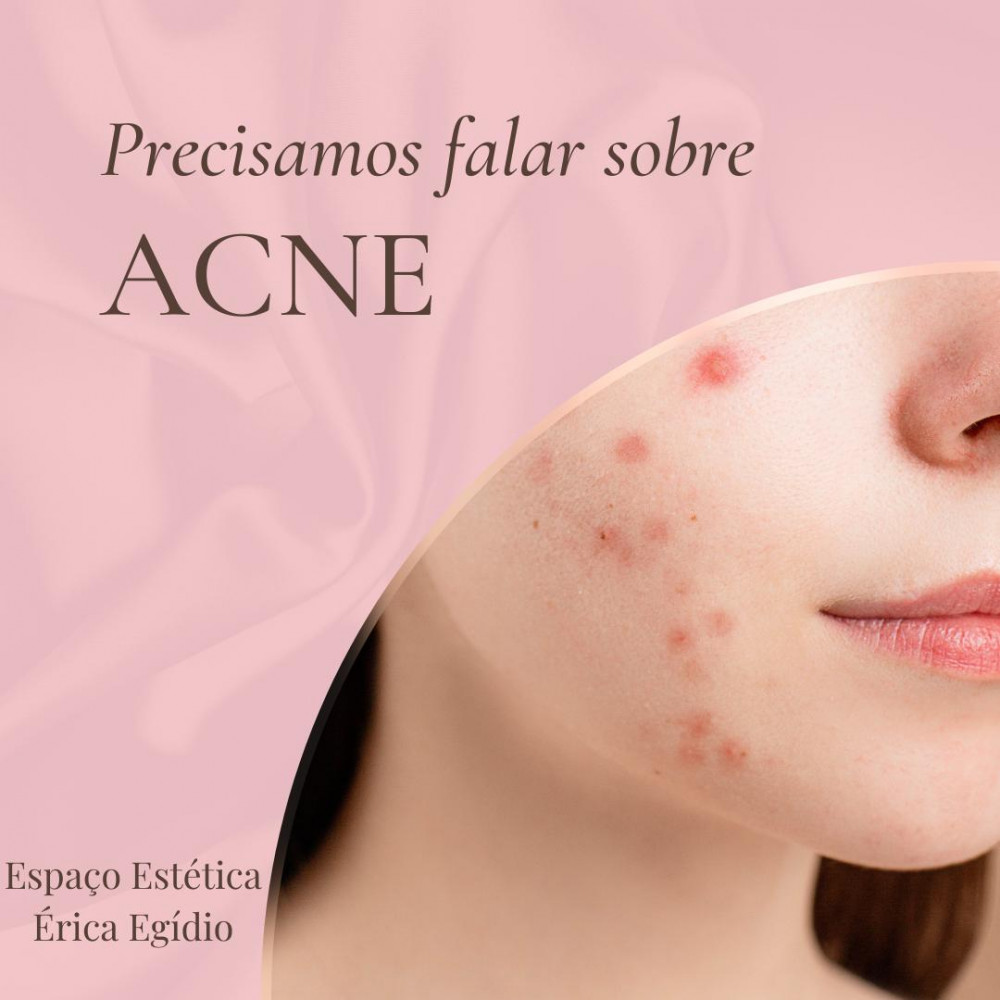 Precisamos falar sobre Acne