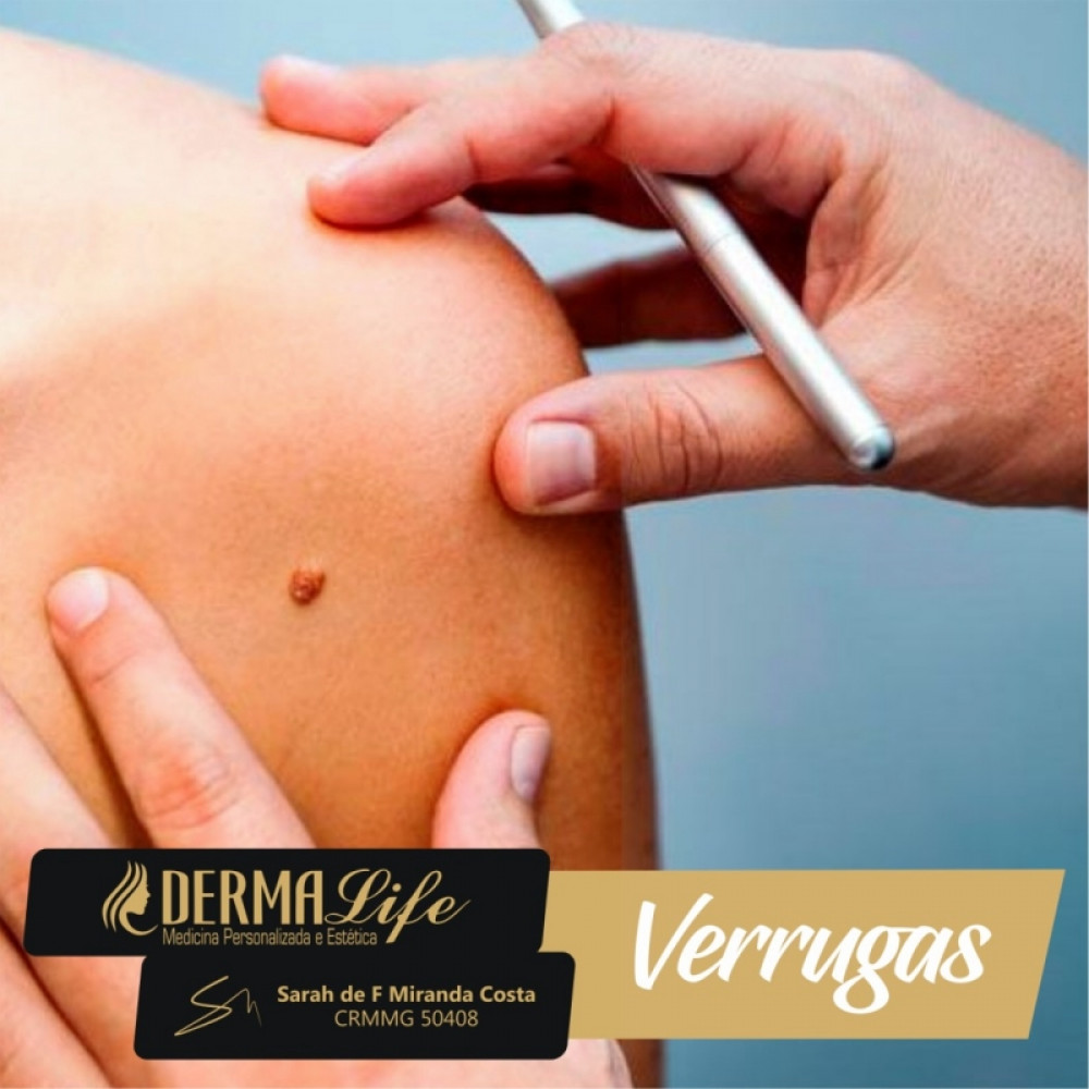 Retirada de verrugas