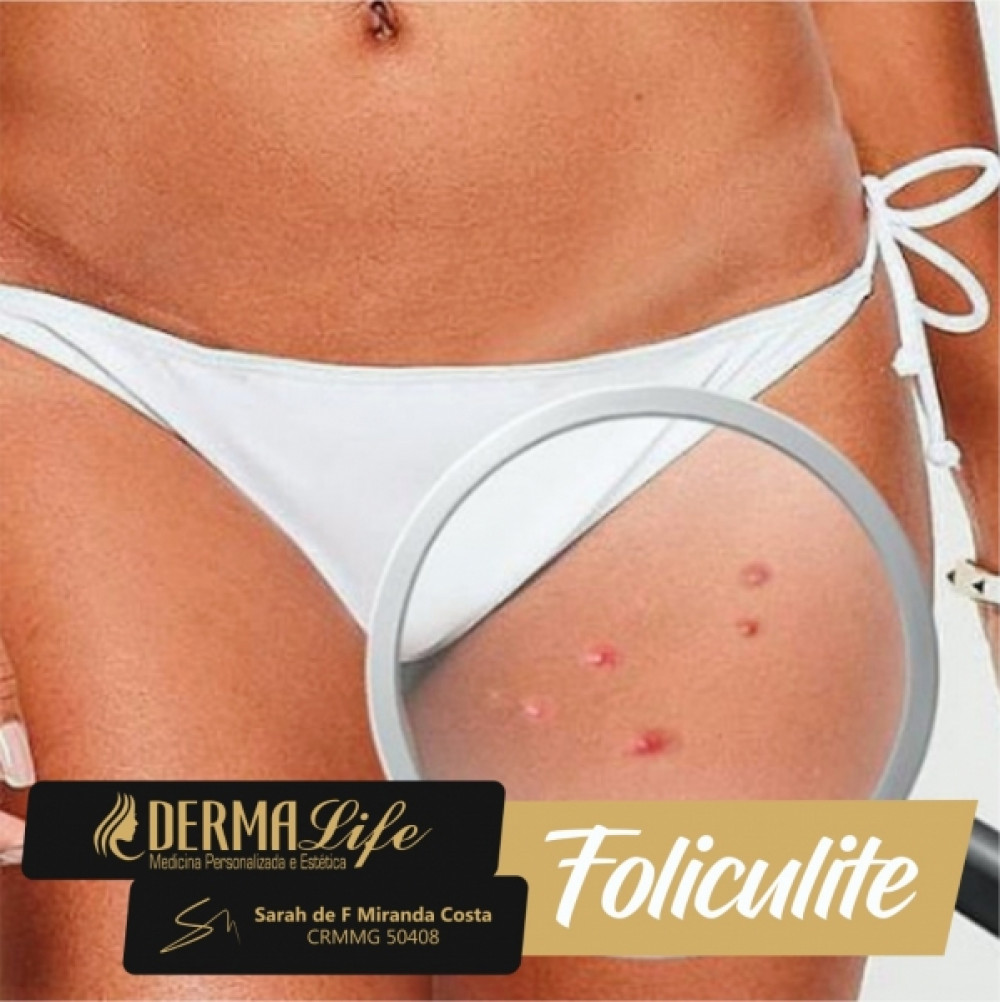Foliculite, como evitar?