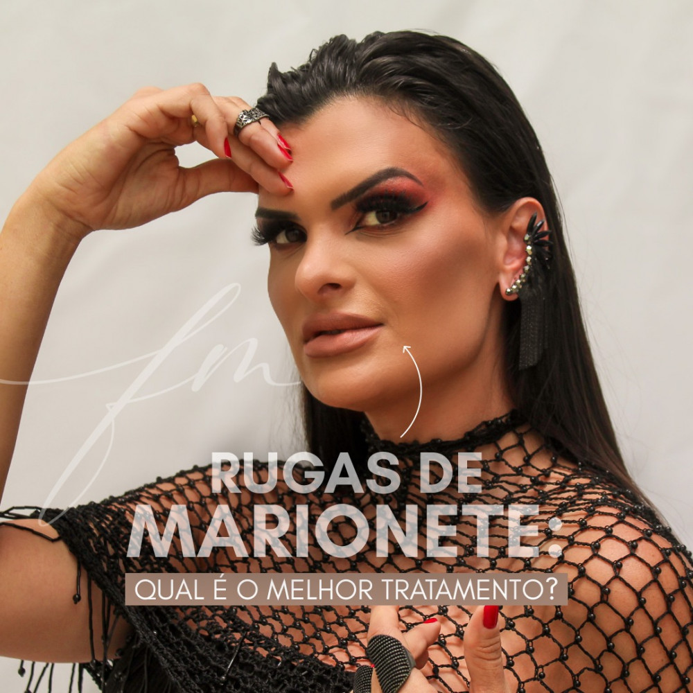 Rugas de marionete: Qual é o melhor tratamento?