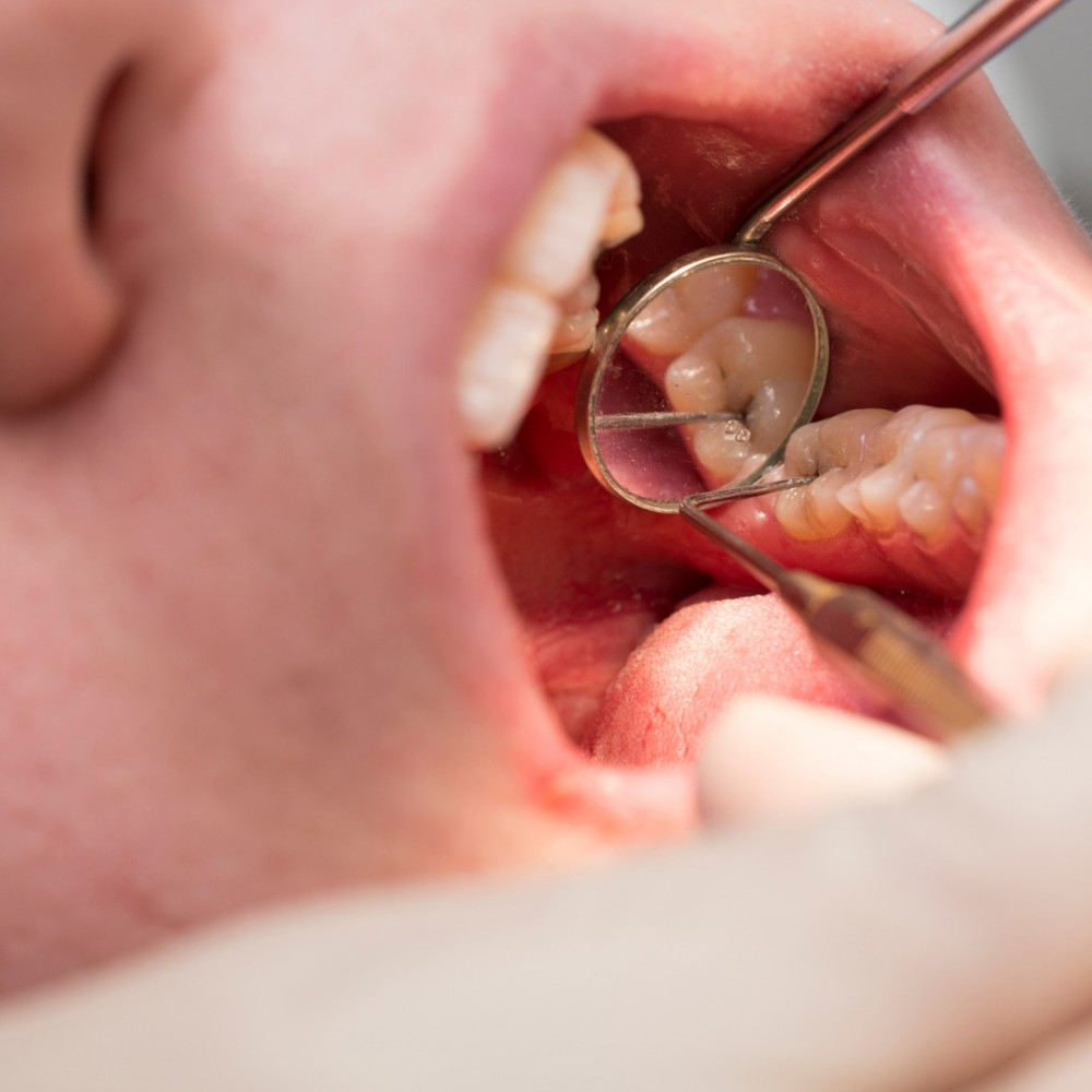 CÁRIE DENTAL