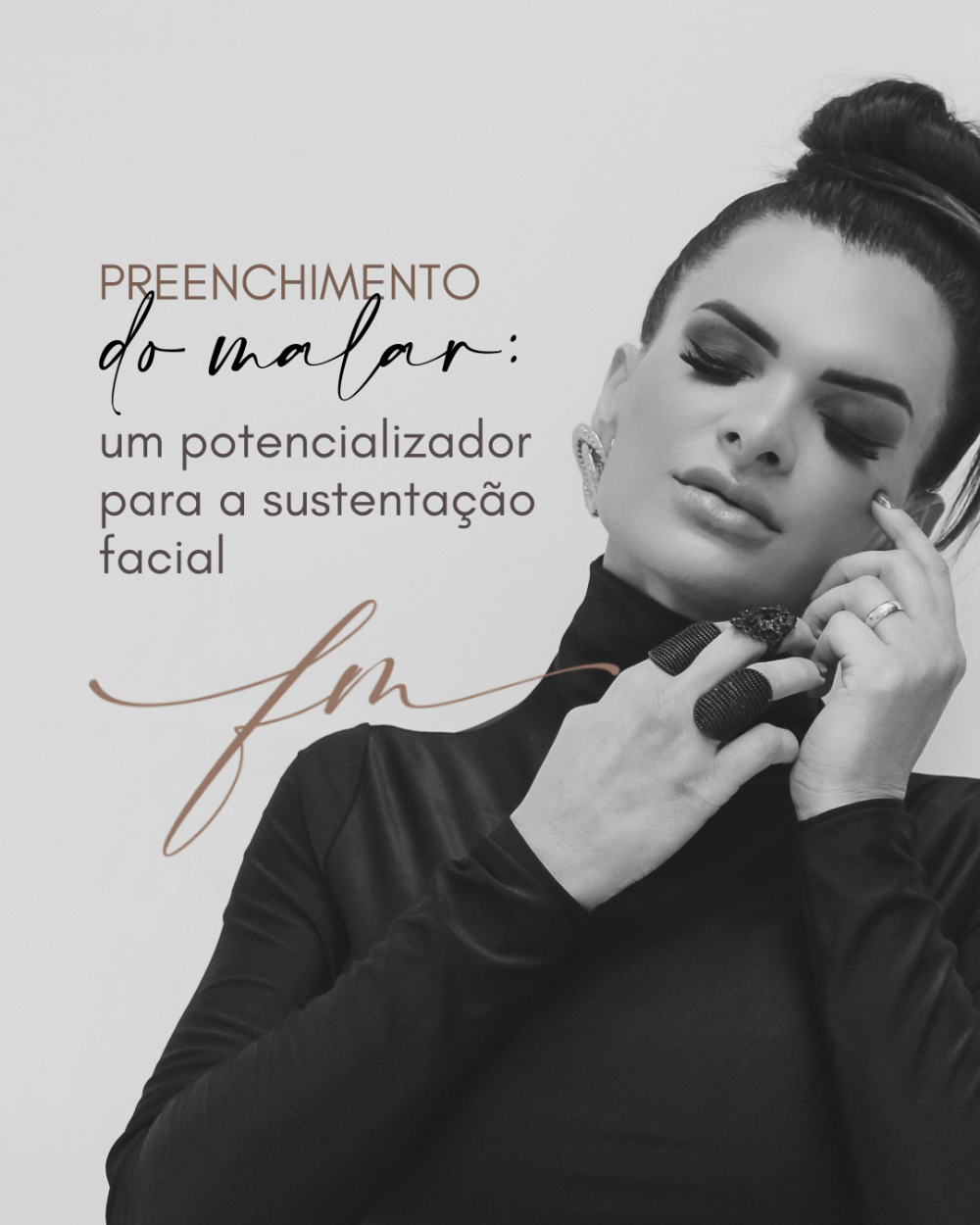 Preenchimento do malar: um potencializador para a sustentação facial