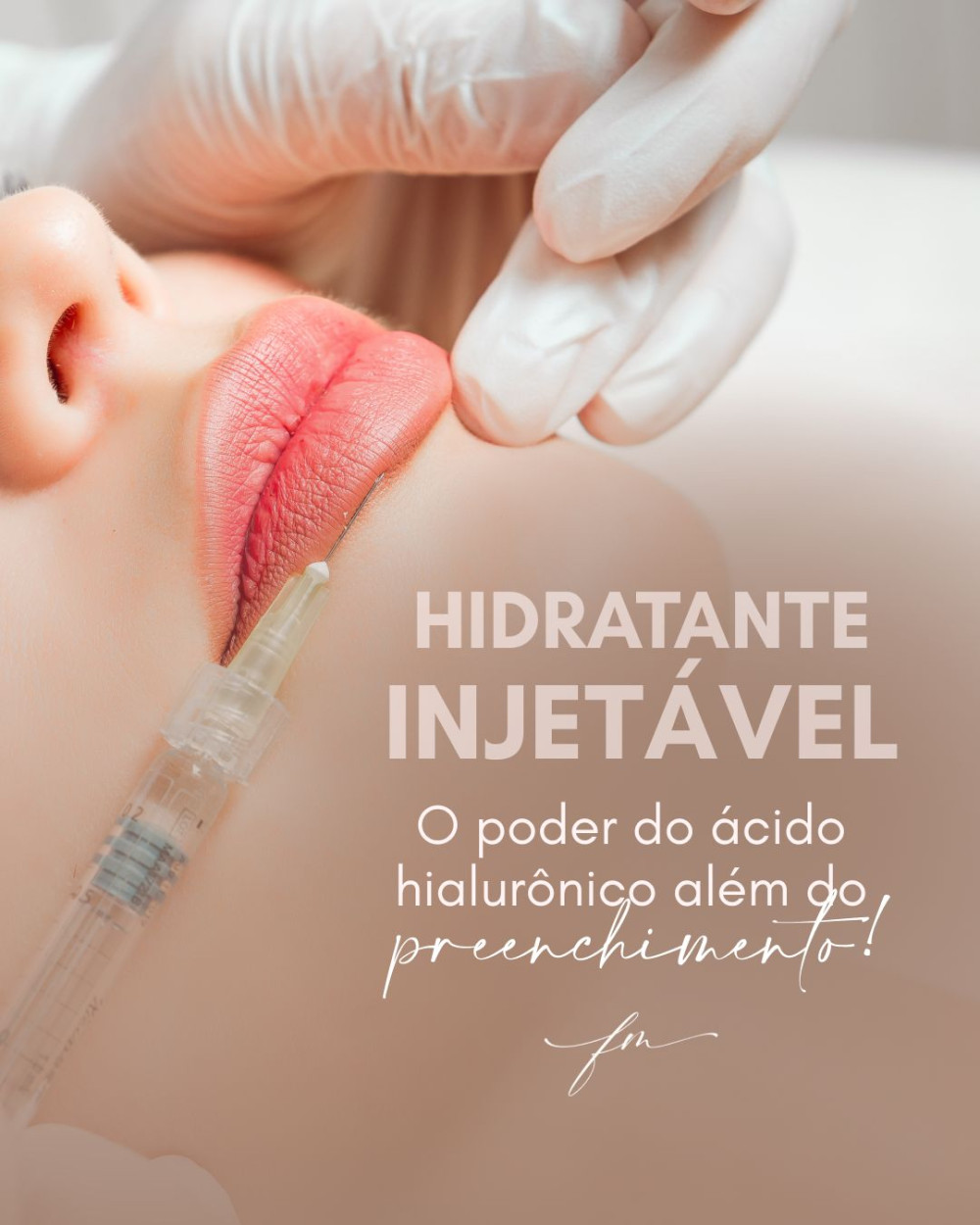 Hidratante injetável - O poder do ácido hialurônico além do preenchimento!