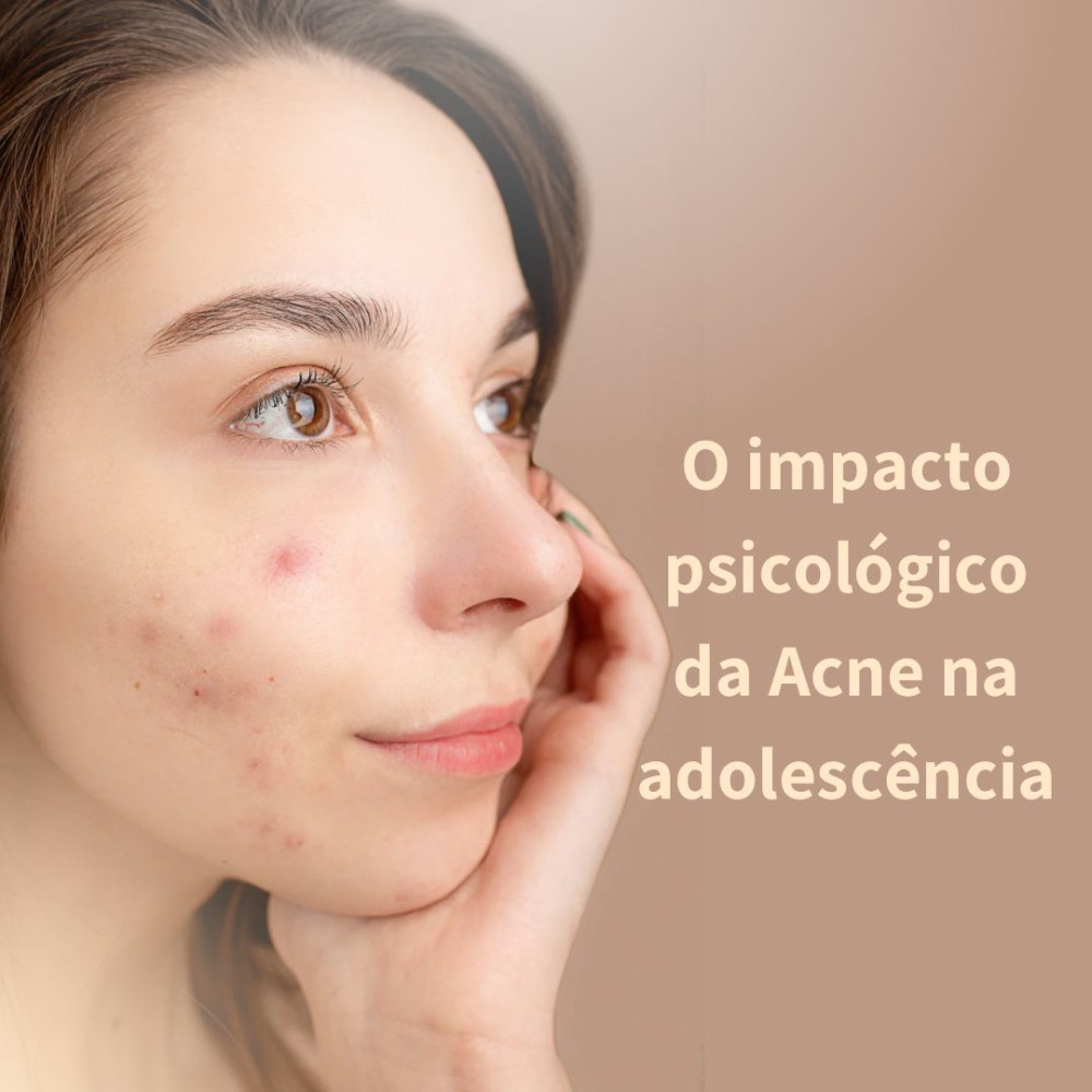O impacto psicológico da Acne na adolescência