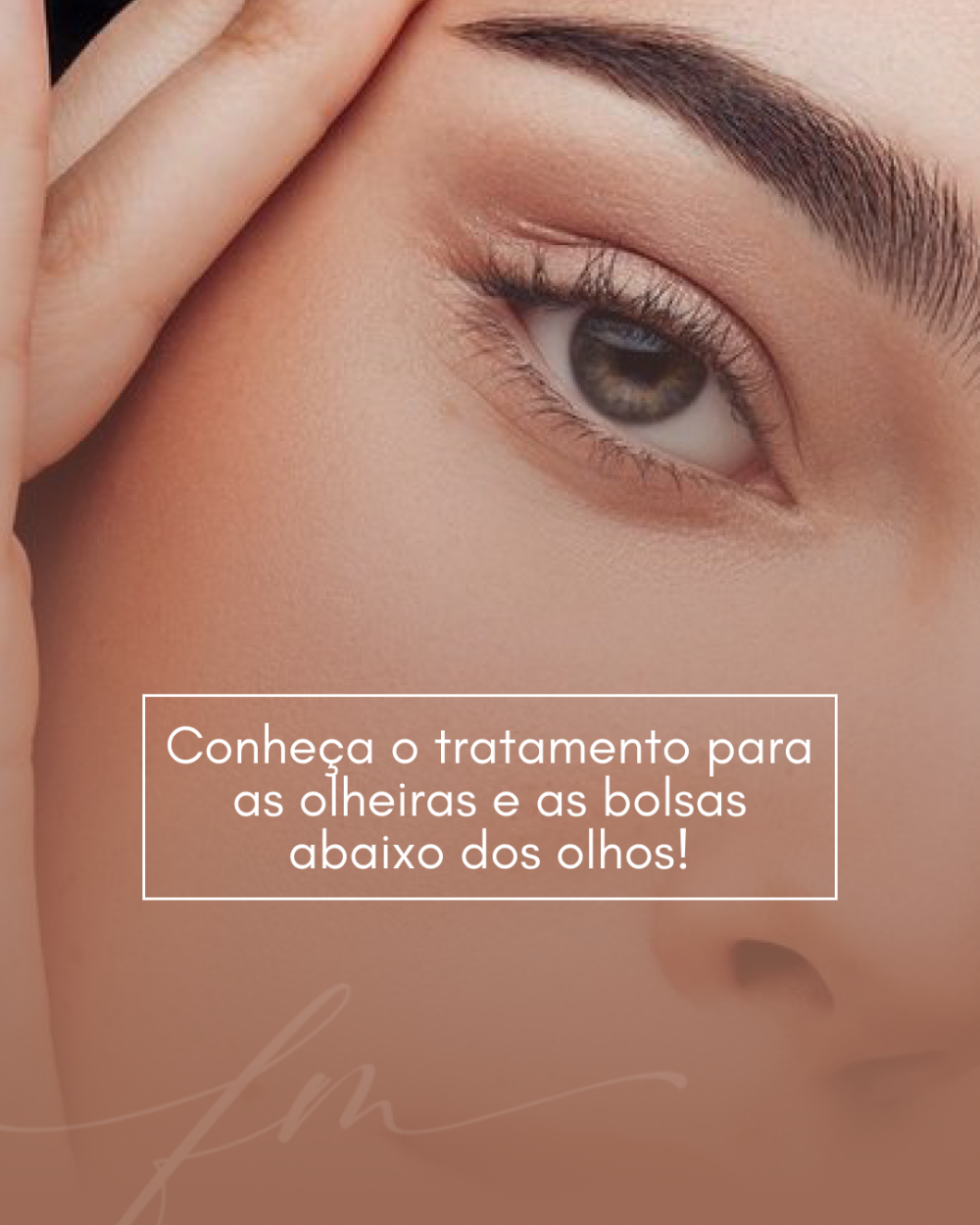 Conheça o tratamento para as olheiras e as bolsas abaixo dos olhos