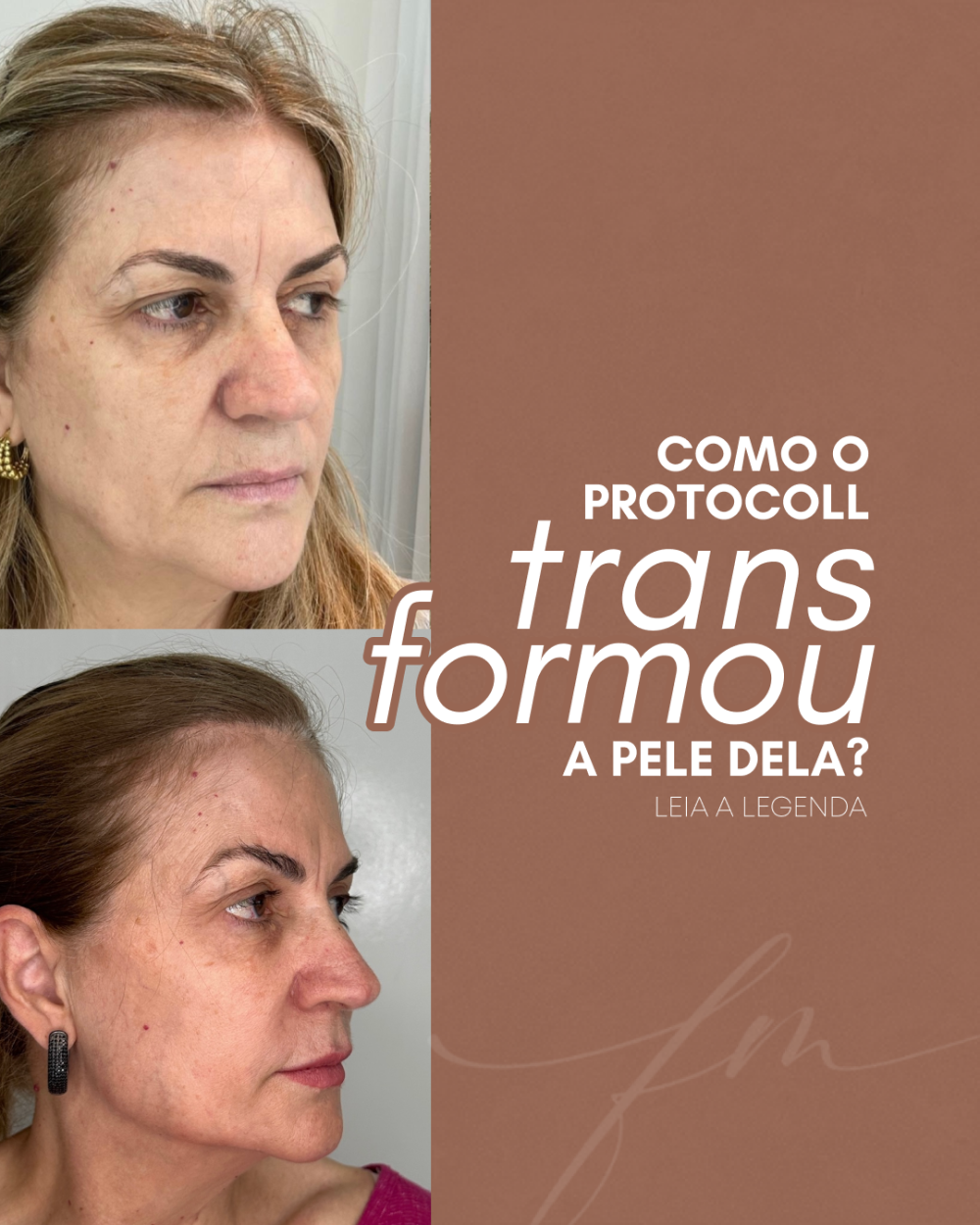 Como o Protocoll transformou a pele dela?