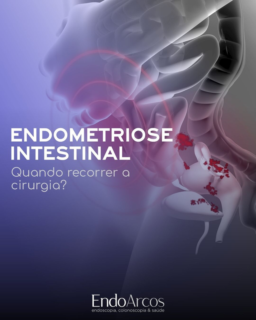 Endometriose Intestinal: quando recorrer à cirurgia?
