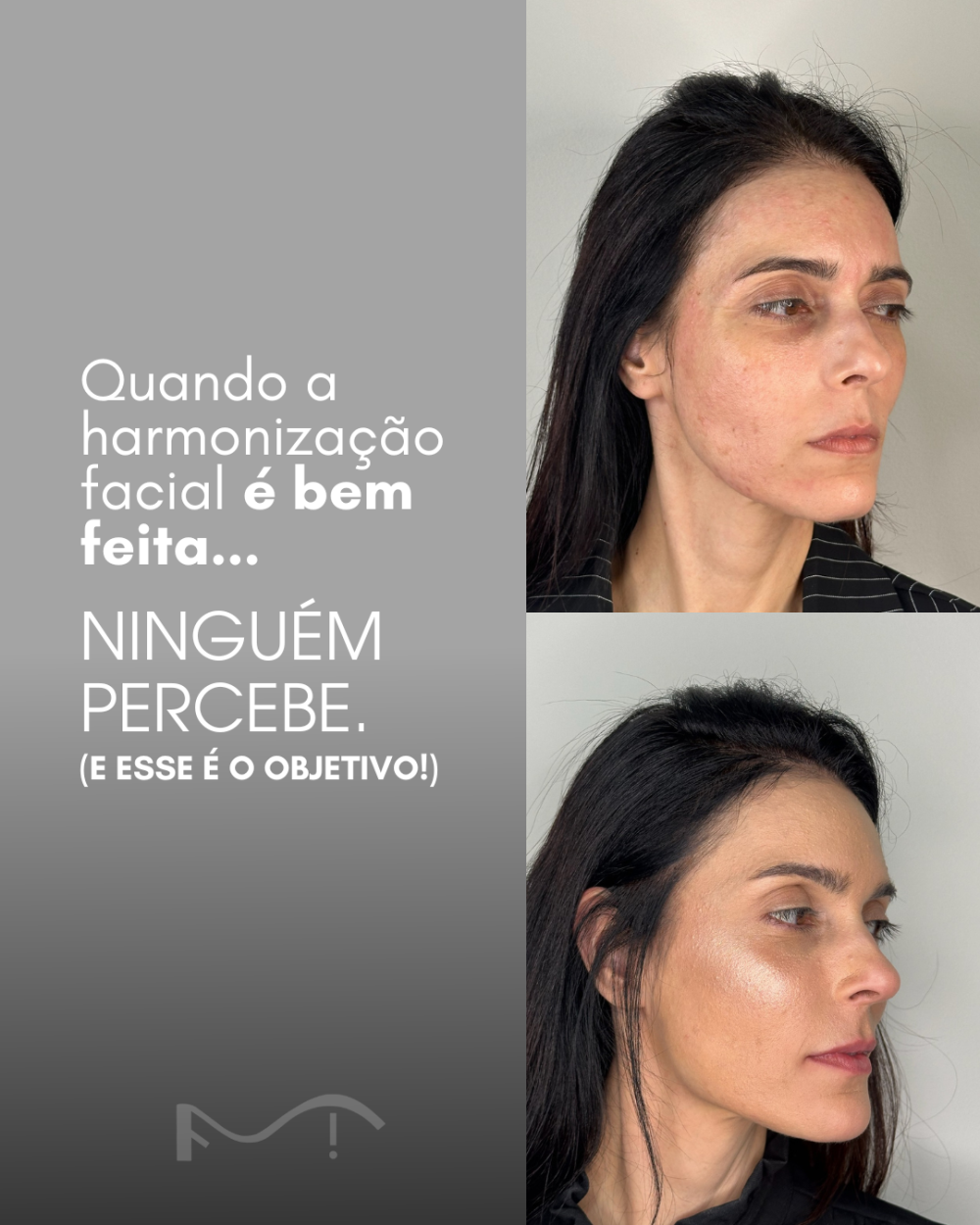 Quando a Harmonização Facial é bem-feita ninguém percebe