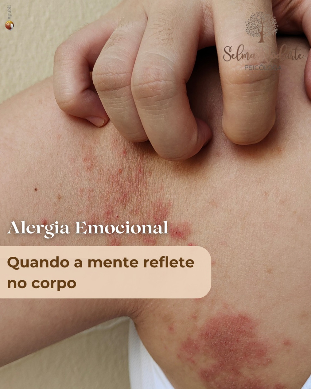 Alergia emocional: quando a mente reflete no corpo