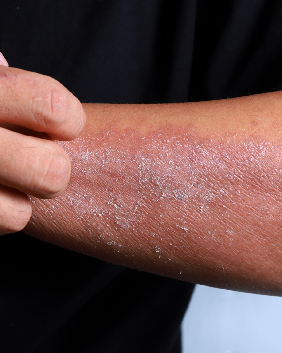 Alergia emocional: Sintomas e diagnóstico